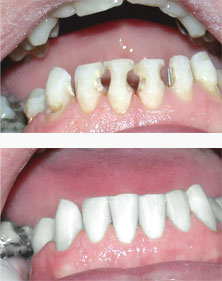 Couronnes dentaire avant et après