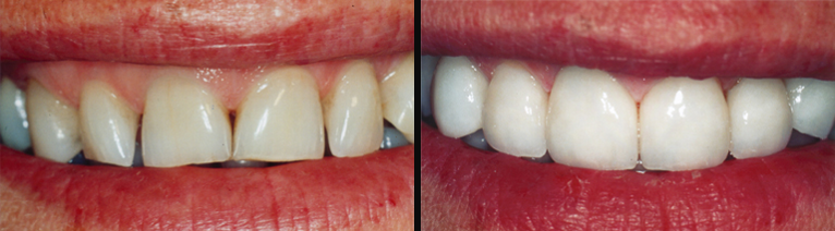 Regain your dazzling smile