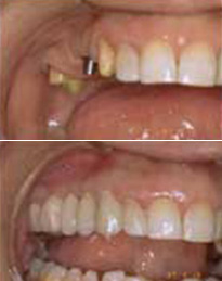 Dental implants