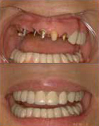 Dental implants