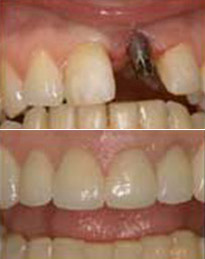 Dental implants